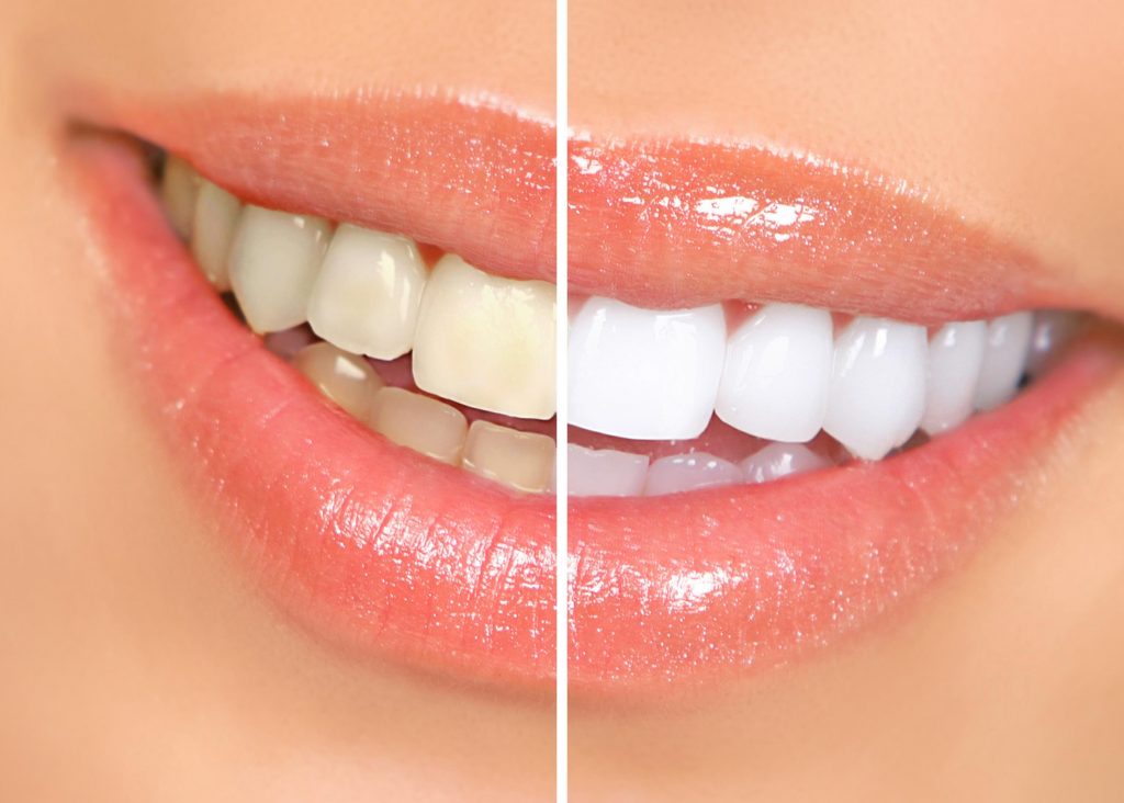7 نکته کلیدی برای سفیدی دندان